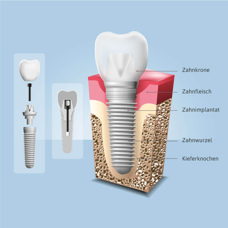 Zahnimplantate in Hamburg - die künstliche Zahnwurzel