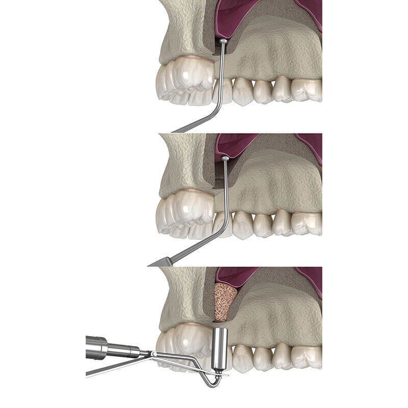 Kieferknochenaufbau mit Sinuslift, Implantation in Hamburg