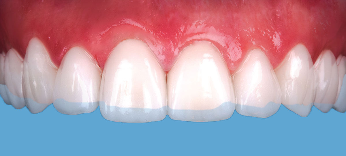 Bisshebung abgenutzter Zahnflächen durch Veneers