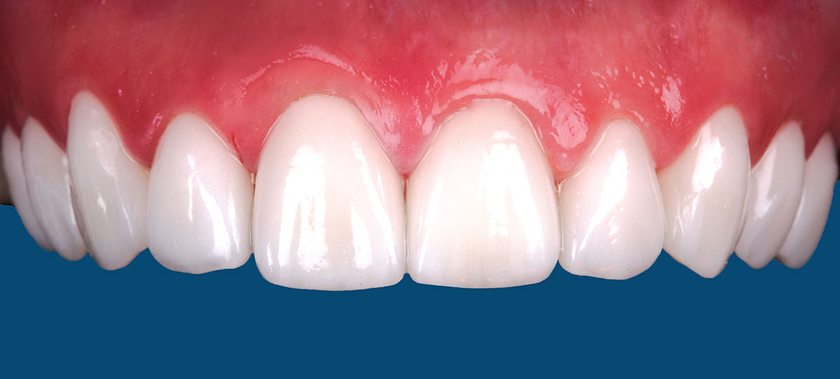 Veneers: Ästhetische Zahnmedizin in Stelle