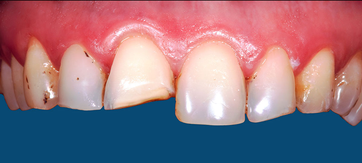 Veneers: Ästhetische Zahnmedizin in Stelle