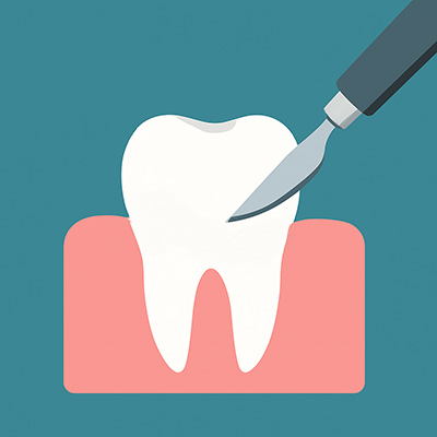Parodontitis_Chirurgie Parodontitis-Behandlung Schritt5