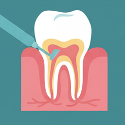 Parodontitis_Wurzeloberflächen_Eingriffe Parodontitis-Behandlung Schritt3
